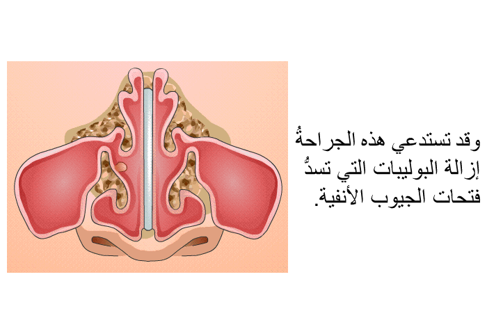 وقد تستدعي هذه الجراحةُ إزالة البوليبات التي تسدُّ فتحات الجيوب الأنفية.