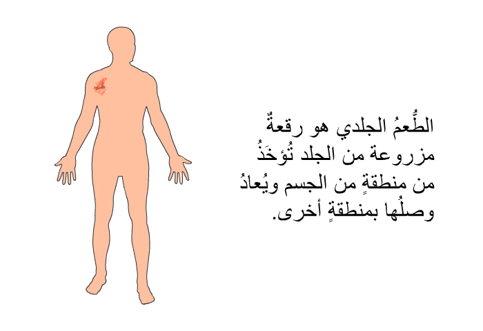 الطُّعمُ الجلدي هو رقعةٌ مزروعة من الجلد، تُؤخَذُ من منطقةٍ من الجسم ويُعادُ وصلُها بمنطقةٍ أخرى.