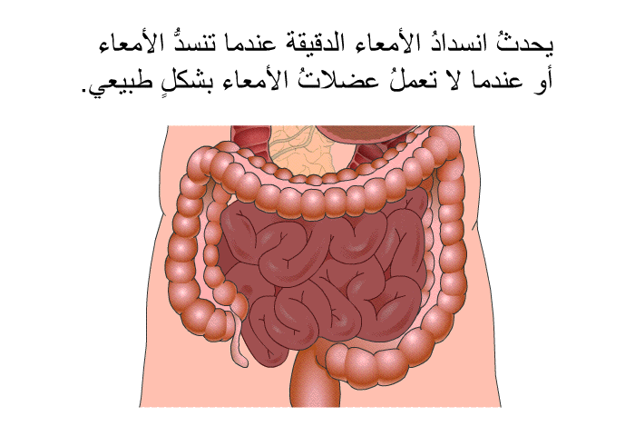 يحدثُ انسدادُ الأمعاء الدقيقة عندما تنسدُّ الأمعاء أو عندما لا تعملُ عضلاتُ الأمعاء بشكلٍ طبيعي.