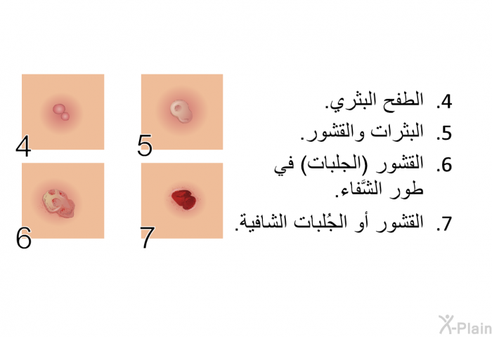 الطفح البثري. البثرات والقشور. القشور (الجلبات) في طور الشَّفاء. القشور أو الجُلبات الشافية.