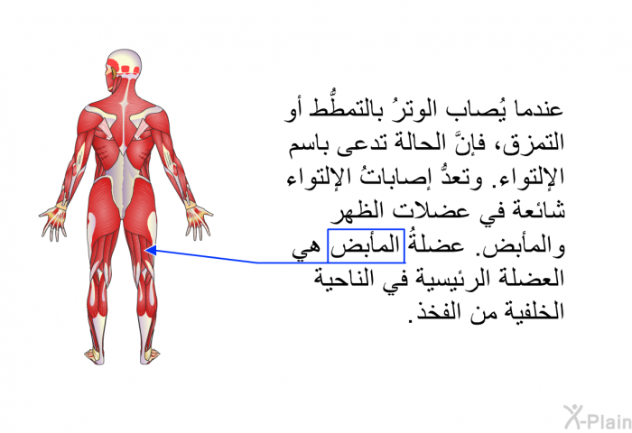 عندما يُصاب الوترُ بالتمطُّط أو التمزق، فإنَّ الحالة تدعى باسم الإلتواء. وتعدُّ إصاباتُ الإلتواء شائعة في عضلات الظهر والمأبض. عضلةُ المأبض هي العضلةَ الرئيسية في الناحية الخلفية من الفخذ.