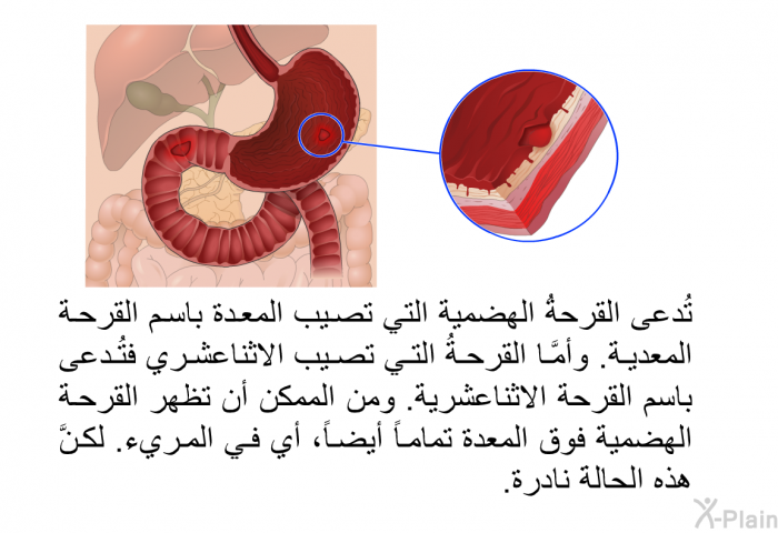 تُدعى القرحةُ الهضمية التي تصيب المعدة باسم القرحة المعدية. وأمَّا القرحةُ التي تصيب الاثناعشري فتُدعى باسم القرحة الاثناعشرية. ومن الممكن أن تظهر القرحة الهضمية فوق المعدة تماماً أيضاً، أي في المريء. لكنَّ هذه الحالةَ نادرة.