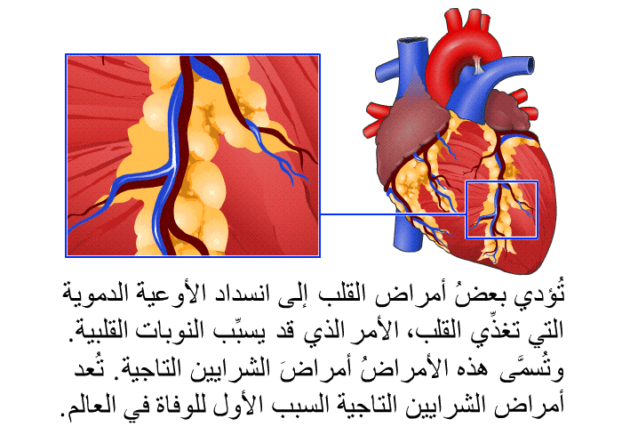 تُؤدي بعضُ أمراض القلب إلى انسداد الأوعيةَ الدموية التي تغذِّي القلب، الأمر الذي قد يسبِّب النوبات القلبية. وتُسمَّى هذه الأمراضُ أمراضَ الشرايين التاجية. تُعد أمراض الشرايين التاجية السبب الأول للوفاة في العالم.