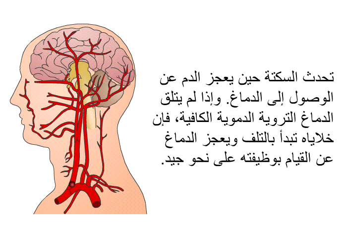 تحدث السكتة حين يعجز الدم عن الوصول إلى الدماغ. وإذا لم يتلق الدماغ التروية الدموية الكافية، فإن خلاياه تبدأ بالتلف ويعجز الدماغ عن القيام بوظيفته على نحو جيد.