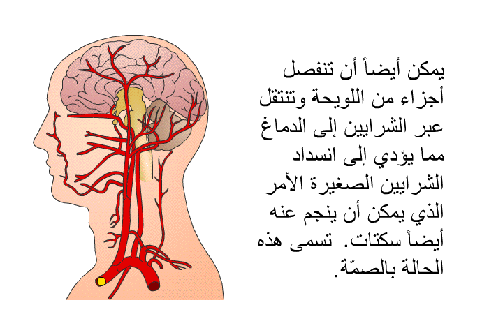 يمكن أيضاً أن تنفصل أجزاء من اللويحة وتنتقل عبر الشرايين إلى الدماغ مما يؤدي إلى انسداد الشرايين الصغيرة الأمر الذي يمكن أن ينجم عنه أيضاً سكتات تسمى هذه الحالة بالصمّة.