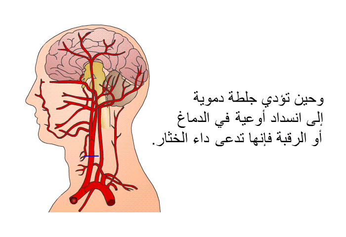 وحين تؤدي جلطة دموية إلى انسداد أوعية دموية في الدماغ أو الرقبة فإنها تدعى داء الخثار.
