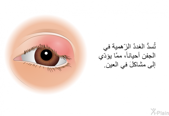 تُسدُّ الغددُ الزّهمية في الجفن أحياناً، ممَّا يؤدّي إلى مشاكلَ في العين.