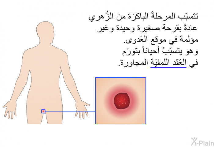 تتسبّب المرحلةُ الباكرَة من الزُّهري عادةً بقرحة صغيرة وحيدة وغير مؤلمة في موقع العَدوى. وهو يتسبّبُ أحياناً بتورّم في العُقد اللمفيّة المجاورة.