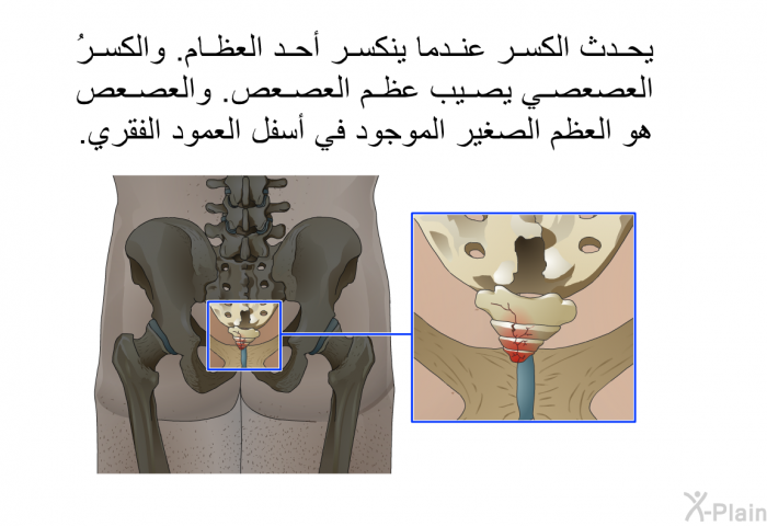 يحدث الكسرُ عندما ينكسر أحد العظام. والكسرُ العصعصي يصيب عظم العصعص. والعصعص هو العظم الصغير الموجود في أسفل العمود الفقري.