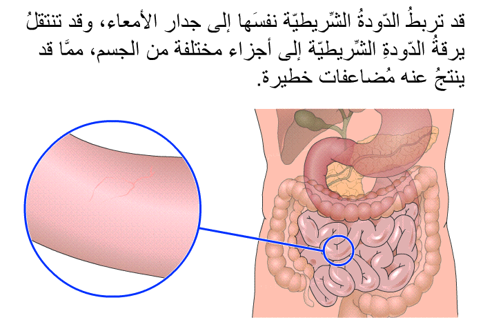 قد تربطُ الدّودةُ الشِّريطيّة نفسَها إلى جدار الأمعاء، وقد تنتقلُ يرقةُ الدّودةِ الشِّريطيّة إلى أجزاء مختلفة من الجسم، ممَّا قد ينتجُ عنه مُضاعفاتٌ خطيرة.