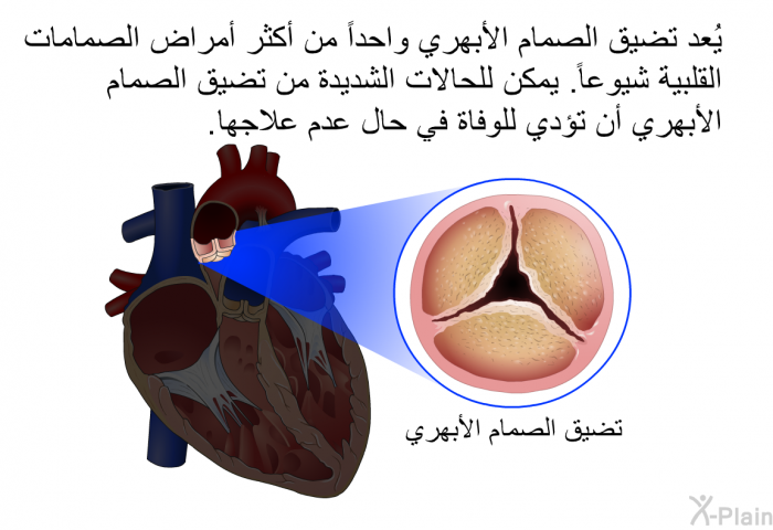 يُعد تضيق الصمام الأبهري واحداً من أكثر أمراض الصمامات القلبية شيوعاً. يمكن للحالات الشديدة من تضيق الصمام الأبهري أن تؤدي للوفاة في حال عدم علاجها.