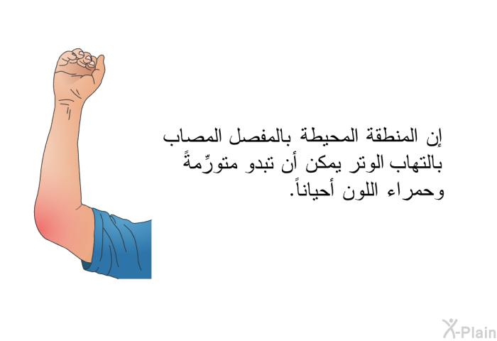 إن المنطقة المحيطة بالمفصل المصاب بالتهاب الوتر يمكن أن تبدو متورِّمةً وحمراء اللون أحياناً.