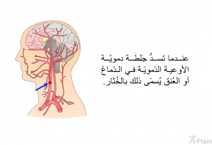 عندما تسدُّ جَلطَة دمويَّة الأوعية الدّمويّة في الدّماغ أو العُنق يُسمّى ذلك بالخُثار.
