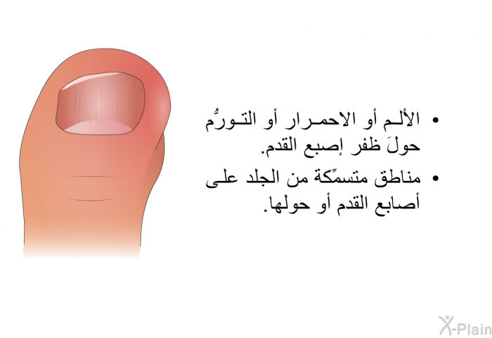 الألم أو الاحمرار أو التورُّم حولَ ظفر إصبع القدم. مناطق متسمِّكة من الجلد على أصابع القدم أو حولها.