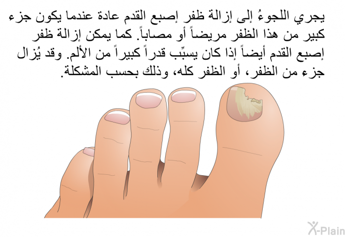يجري اللجوءُ إلى إزالة ظفر إصبع القدم عادة عندما يكون جزء كبير من هذا الظفر مريضاً أو مصاباً. كما يمكن إزالة ظفر إصبع القدم أيضاً إذا كان يسبِّب قدراً كبيراً من الألم. وقد يُزال جزءٌ من الظفر، أو الظفر كله، وذلك بحسب المشكلة.