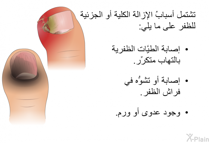 تشتمل أسبابُ الإزالة الكلية أو الجزئية للظفر على ما يلي:  إصابة الطيَّات الظفرية بالتهاب متكرِّر. إصابة أو تشوُّه في فراش الظفر. وجود عدوى أو ورم.