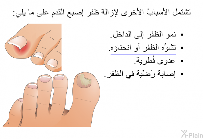 تشتمل الأسبابُ الأخرى لإزالة ظفر إصبع القدم على ما يلي:  نمو الظفر إلى الداخل. تشوُّه الظفر أو انحناؤه. عدوى فُطرية. إصابة رَضِّية في الظفر.