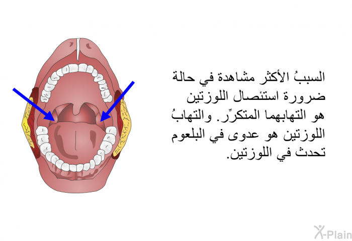 السببُ الأكثر مشاهدة في حالة ضرورة استئصال اللوزتين هو التهابهما المتكرِّر. والتهابُ اللوزتين هو عدوى في البلعوم تحدث في اللوزتين.