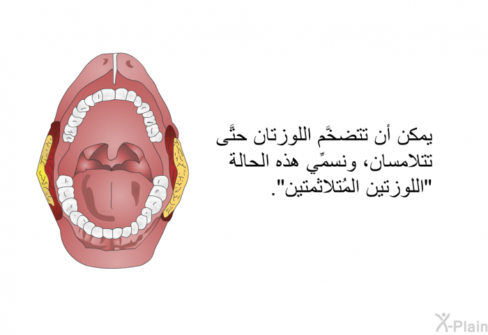 يمكن أن تتضخَّم اللوزتان حتَّى تتلامسان، ونسمِّي هذه الحالة 