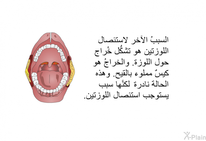 السببُ الآخر لاستئصال اللوزتين هو تشكُّل خُراج حول اللوزة. والخراجُ هو كيسٌ مملوء بالقيح. وهذه الحالة نادرة، لكنَّها سبب يستوجب استئصال اللوزتين.