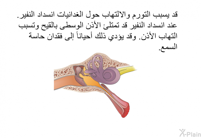 قد يسبب التورم والالتهاب حول الغدانيات انسداد النفير. عند انسداد النفير قد تمتلئ الأذن الوسطى بالقيح وتسبب التهاب الأذن. وقد يؤدي ذلك أحياناً إلى فقدان حاسة السمع.