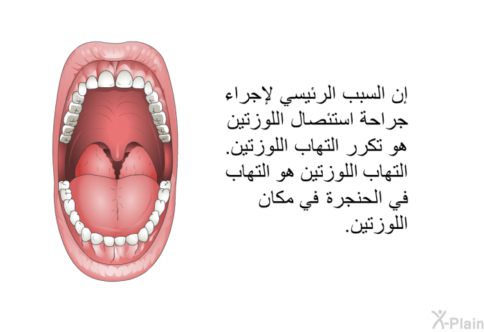 إن السبب الرئيسي لإجراء جراحة إستئصال اللوزتين هو تكرر التهاب اللوزتين. التهاب اللوزتين هو التهاب في الحنجرة في مكان اللوزتين.