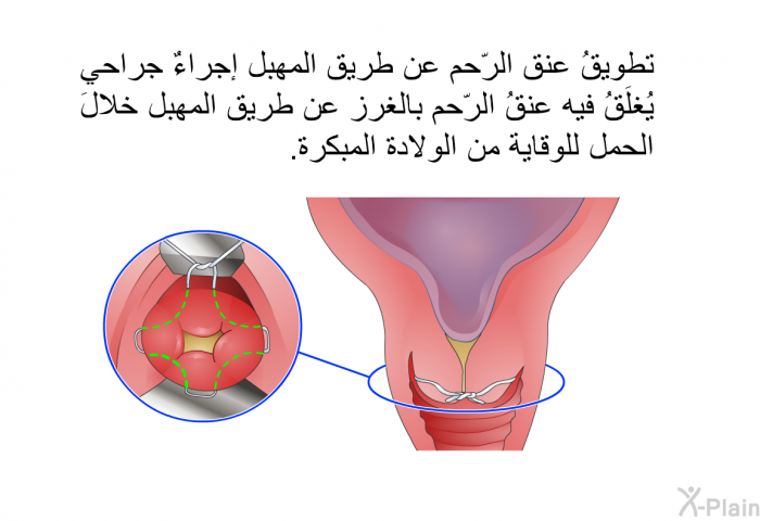 تطويقُ عنقِ الرّحم عن طريق المَهبِل إجراءٌ جراحي يُغلَقُ فيه عنقُ الرّحم بالغرز عن طريق المَهبِل خلالَ الحمل للوقاية من الولادة المبكرة.