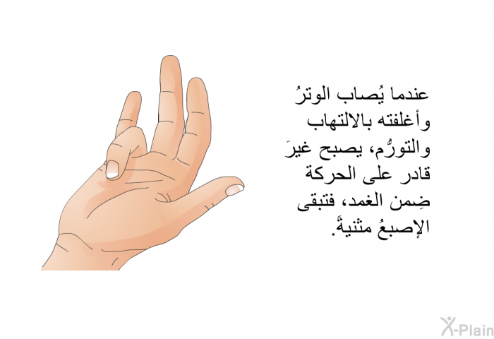 عندما يُصاب الوترُ وأغلفته بالالتهاب والتورُّم، يصبح غيرَ قادر على الحركة ضِمن الغمد، فتبقى الإصبعُ مثنيةً.