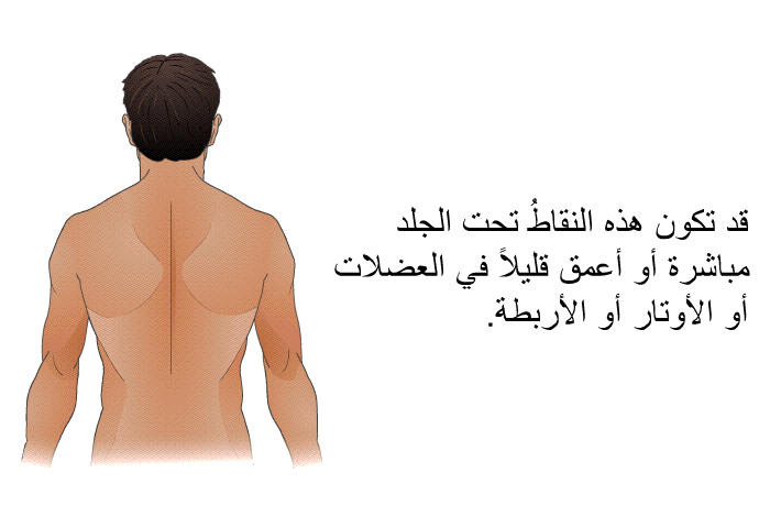 قد تكون هذه النقاطُ تحت الجلد مباشرة أو أعمق قليلاً في العضلات أو الأوتار أو الأربطة<B>.</B>