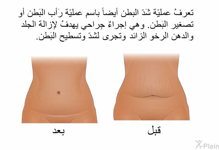 تعرفُ عمليّة شَدّ البطن أيضاً باسم عمليّة رَأب البَطن أو تصغير البَطن. وهي إجراءٌ جِراحي يهدفُ لإزالة الجلد والدهن الرخو الزائد، وتجرى لشدّ وتسطيح البَطن.