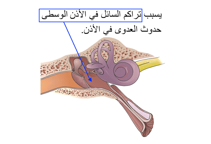 يسبب تراكم السائل في الأذن الوسطى حدوث العدوى في الأذن.