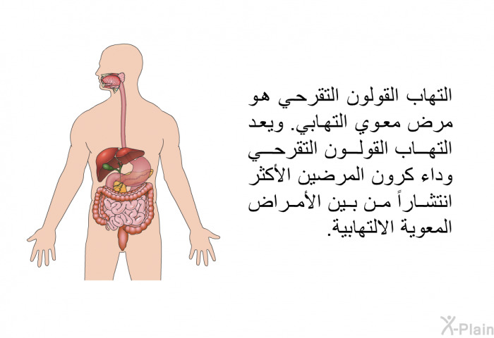 التهاب القولون التقرحي هو مرض معوي التهابي. ويعد التهاب القولون التقرحي وداء كرون المرضين الأكثر انتشاراً من بين الأمراض المعوية الالتهابية.