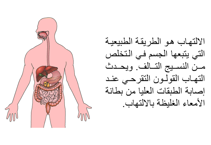 الالتهاب هو الطريقة الطبيعية التي يتبعها الجسم في التخلص من النسيج التالف. ويحدث التهاب القولون التقرحي عند إصابة الطبقات العليا من بطانة الأمعاء الغليظة بالالتهاب.