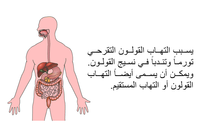 يسبب التهاب القولون التقرحي تورماً وتندباً في نسيج القولون. ويمكن أن يسمى أيضاً التهاب القولون أو التهاب المستقيم.