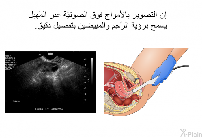 إن التصوير بالأمواج فوق الصوتيّة عبر المَهبِل يسمح برؤية الرَّحِم والمبيضين بتفصيل دقيق.