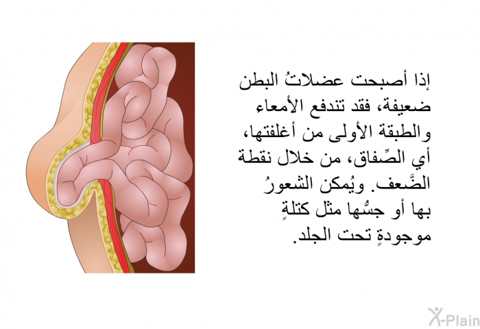 إذا أصبحت عضلاتُ البطن ضعيفةً، فقد تندفع الأمعاء والطبقة الأولى من أغلفتها، أي الصِّفاق، من خلال نقطة الضَّعف. ويُمكن الشعورُ بها أو جسُّها مثل كتلةٍ موجودةٍ تحت الجلد.