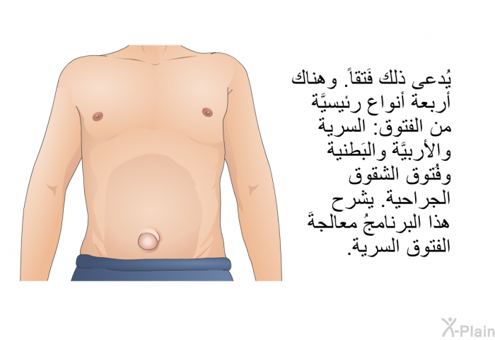 يُدعى ذلك فَتقاً. وهناك أربعةُ أنواع رئيسيَّة من الفتوق: السُّرِّية والأُربيَّة والبَطنية وفُتوق الشقوق الجراحية. تشرح هذه المعلومات الصحية معالجةَ الفتوق السُّرِّية.