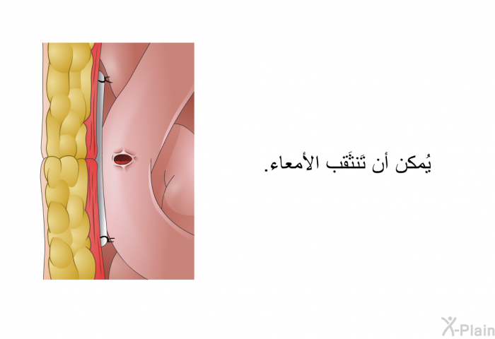 يُمكن أن تَنثَقب الأمعاء.