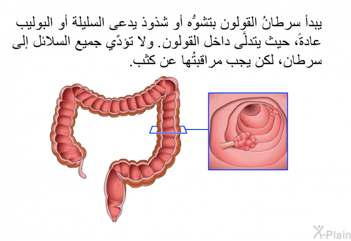 يبدأ سرطانُ القولون بتشوُّه أو شذوذ يدعى السليلة أو البوليب عادةً، حيث يتدلَّى داخل القولون. ولا تؤدِّي جميع السلائل إلى سرطان، لكن يجب مراقبتُها عن كثب.