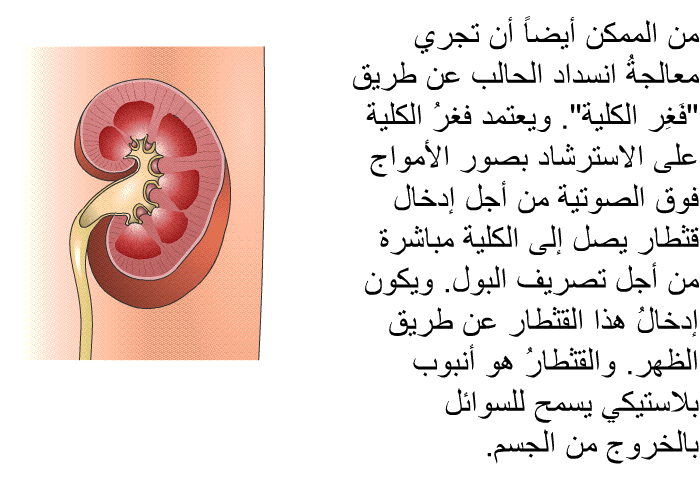 من الممكن أيضاً أن تجري معالجةُ انسداد الحالب عن طريق "فَغِر الكلية". ويعتمد فغرُ الكلية على الاسترشاد بصور الأمواج فوق الصوتية من أجل إدخال قثطار يصل إلى الكلية مباشرة من أجل تصريف البول. ويكون إدخالُ هذا القثطار عن طريق الظهر. والقثطارُ هو أنبوب بلاستيكي يسمح للسوائل بالخروج من الجسم.