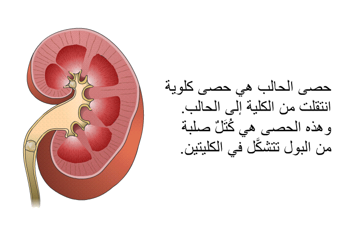 حصى الحالب هي حصى كلوية انتقلت من الكلية إلى الحالب. وهذه الحصى هي كُتَلٌ صلبة من البول تتشكَّل في الكليتين.