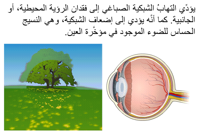 يؤدِّي التهابُ الشبكية الصباغي إلى فقدان الرؤية المحيطية، أو الجانبية. كما أنَّه يؤدي إلى إضعاف الشبكية، وهي النسيج الحساس للضوء الموجود في مؤخَّرة العين.