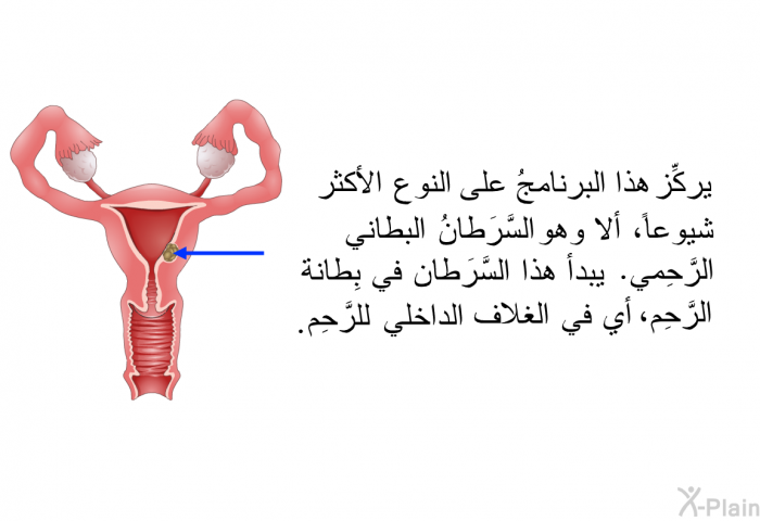 وتركِّز هذه المعلومات الصحية على النوع الأكثر شيوعاً، ألا وهو السَّرَطانُ البطاني الرَّحِمي. يبدأ هذا السَّرَطانُ في بِطانة الرَّحِم، أي في الغلاف الداخلي للرَّحِم.