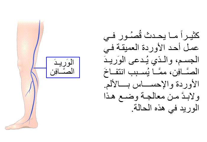كثيراً ما يحدث قُصُورٌ في عمل أحد الأوردة العميقة في الجسم، والذي يُدعى الوَريدَ الصَّافِن، ممَّا يُسبب انتفاخَ الأوردة والإحساس بالألم<B>. </B>ولابدَّ من معالجة وضع هذا الوريد في هذه الحالة<B>.</B>