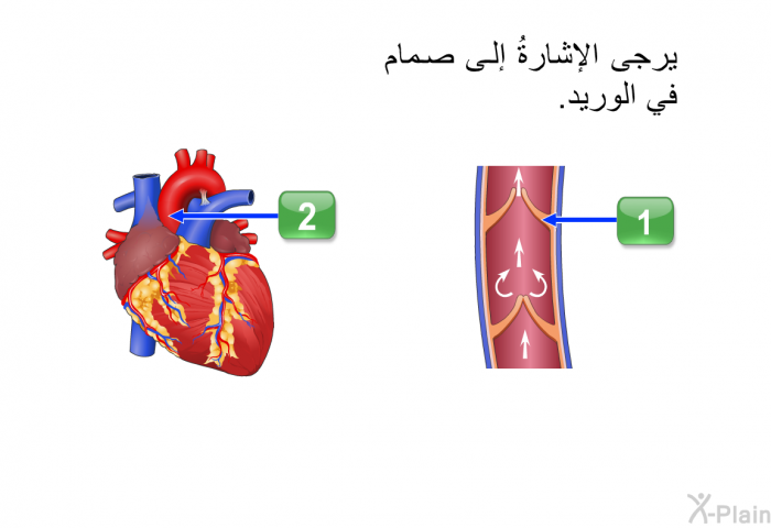 يرجى الإشارةُ إلى صمام في الوريد<B>. </B>