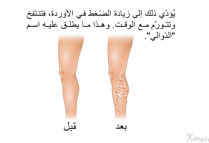 يُؤدِّي ذلك إلى زيادة الضّغط في الأوردة، فتنتفخ وتتورَّم مع الوقت<B>. </B>وهذا ما يطلق عليه اسم <B>"</B>الدّوالي<B>". </B>