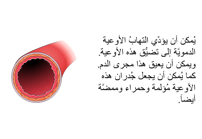 يُمكن أن يؤدِّي التهابُ الأوعية الدمويَّة إلى تضيُّق هذه الأوعية. ويمكن أن يعيق هذا مجرى الدم. كما يُمكن أن يجعل جُدران هذه الأوعية مُؤلمة وحمراء وممضَّة أيضاً.