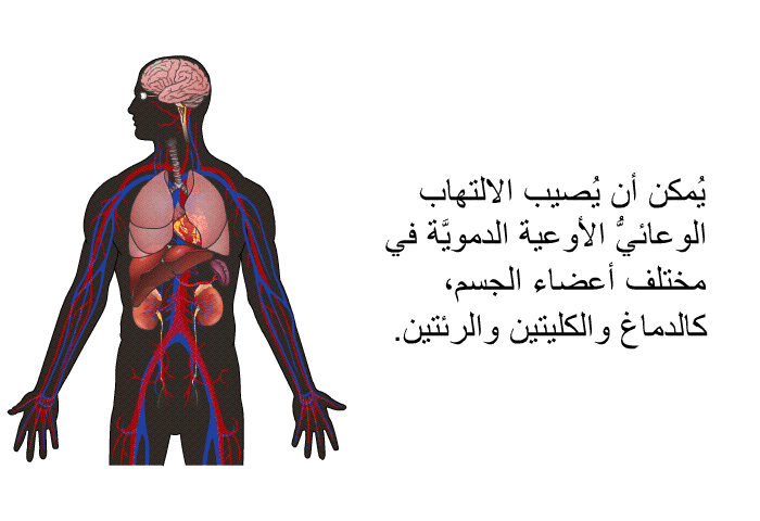 يُمكن أن يُصيب الالتهاب الوعائيُّ الأوعية الدمويَّة في مختلف أعضاء الجسم، كالدماغ والكليتين والرئتين.