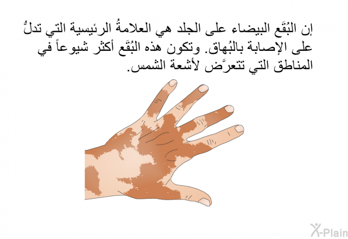 إن البُقَع البيضاء على الجلد هي العلامةُ الرئيسية التي تدلُّ على الإصابة بالبُهاق. وتكون هذه البُقَع أكثر شيوعاً في المناطق التي تتعرَّض لأشعة الشمس.