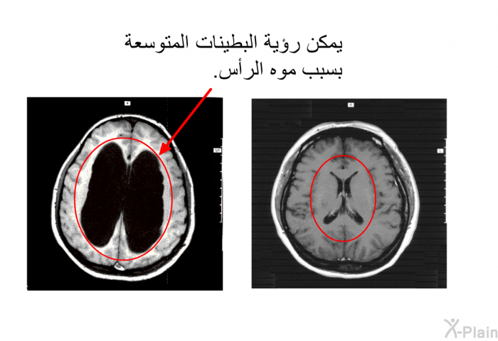 يُمكن رُؤية البُطَينات المُتوَسِّعة بسبب مَوَه الرَّأس.